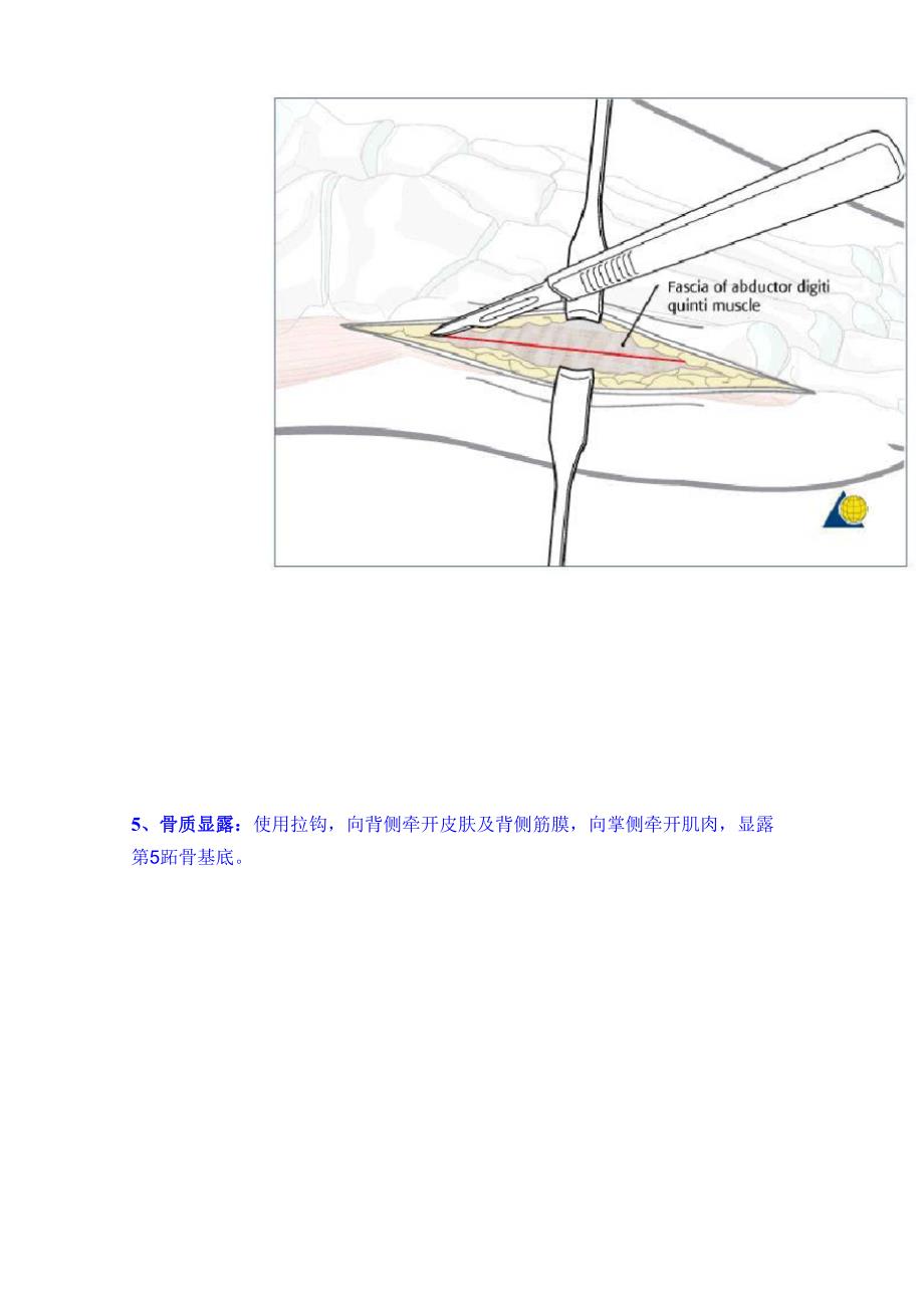 jones骨折手术入路_第4页