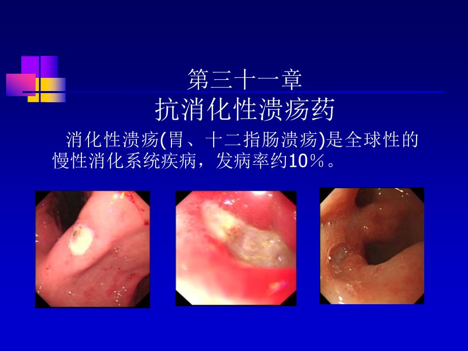 消化性溃疡病_第1页