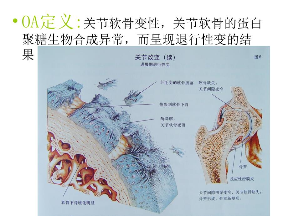 小针刀治疗膝关节骨性关节炎_第3页