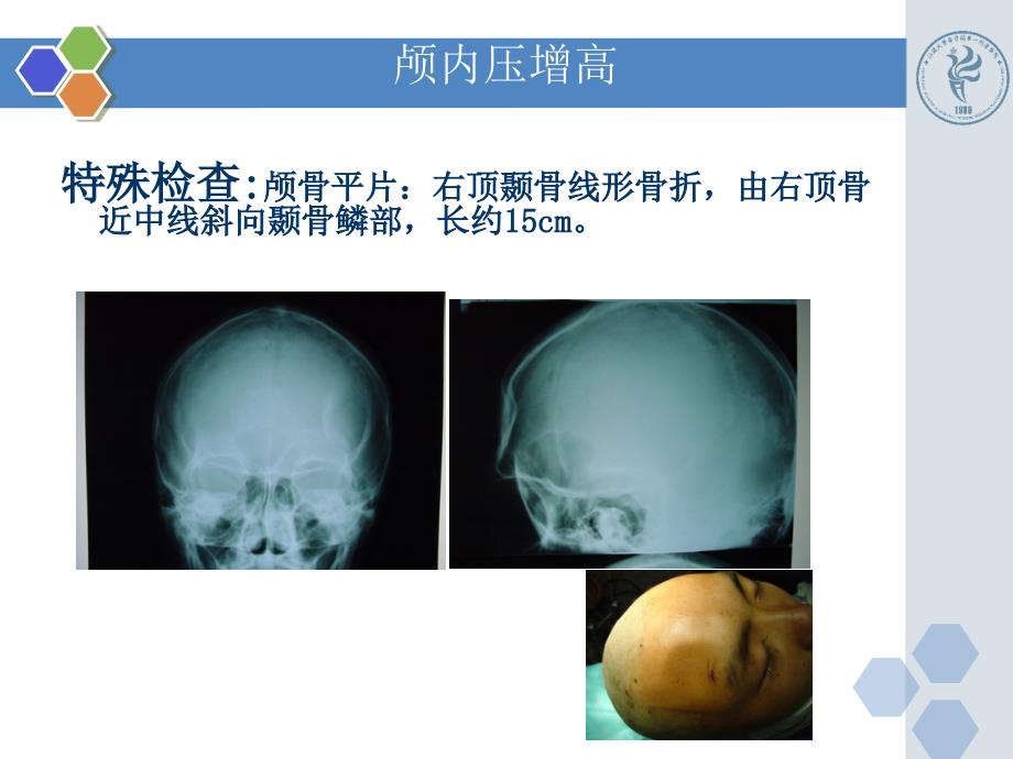 已编新颅脑伤病例ppt课件_第4页