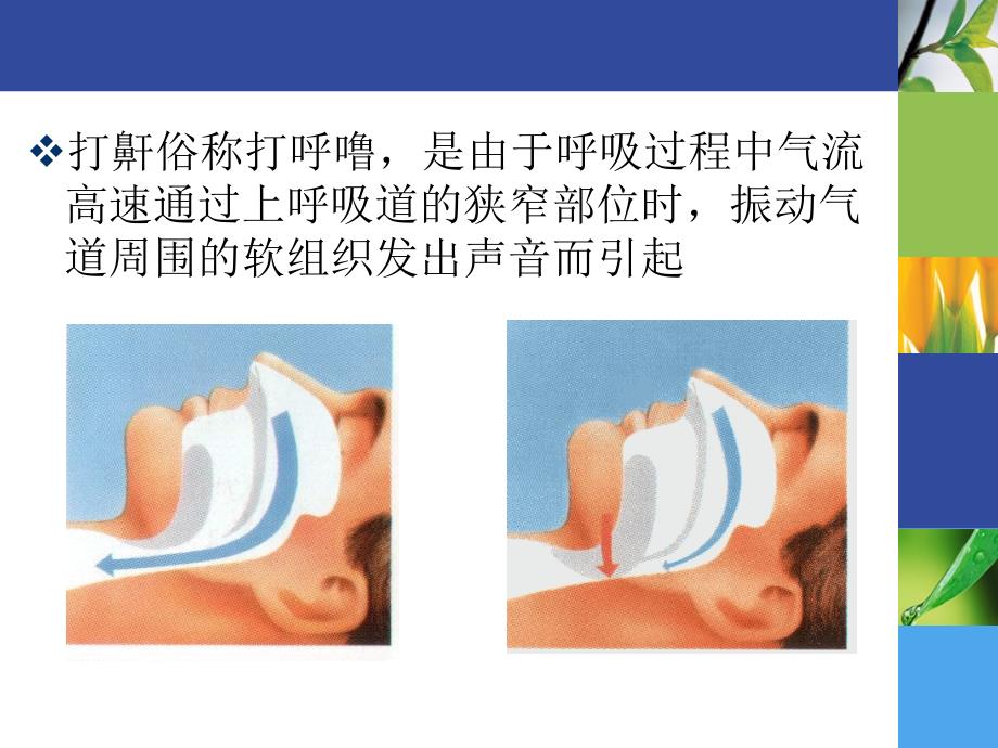 打鼾与睡眠呼吸暂停综合征_第3页