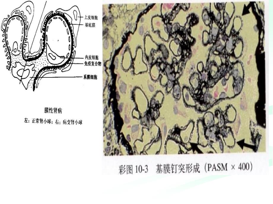 特发性膜性肾病治疗策略_第3页