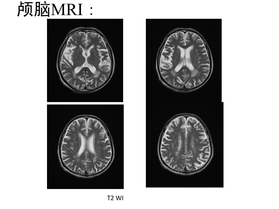 脑小血管病的诊断及治疗_第4页