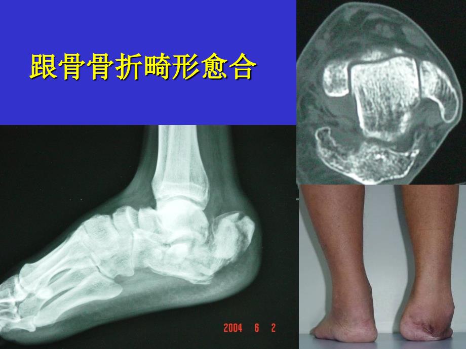 跟骨畸形愈合治疗PPT课件_第2页