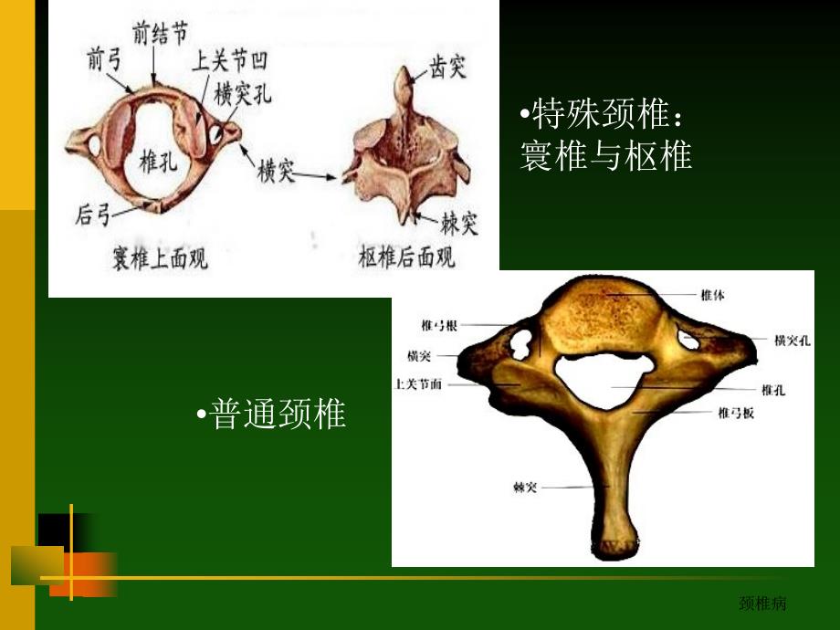 颈椎病的诊治PPT课件_第4页