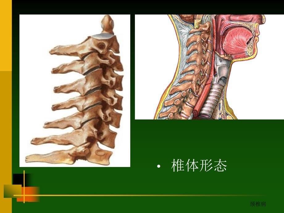 颈椎病的诊治PPT课件_第5页