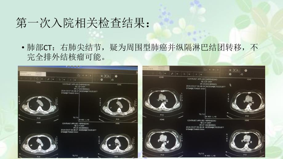 肺结核合并肺癌低PPT课件_第3页