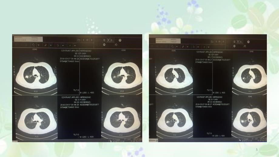 肺结核合并肺癌低PPT课件_第5页