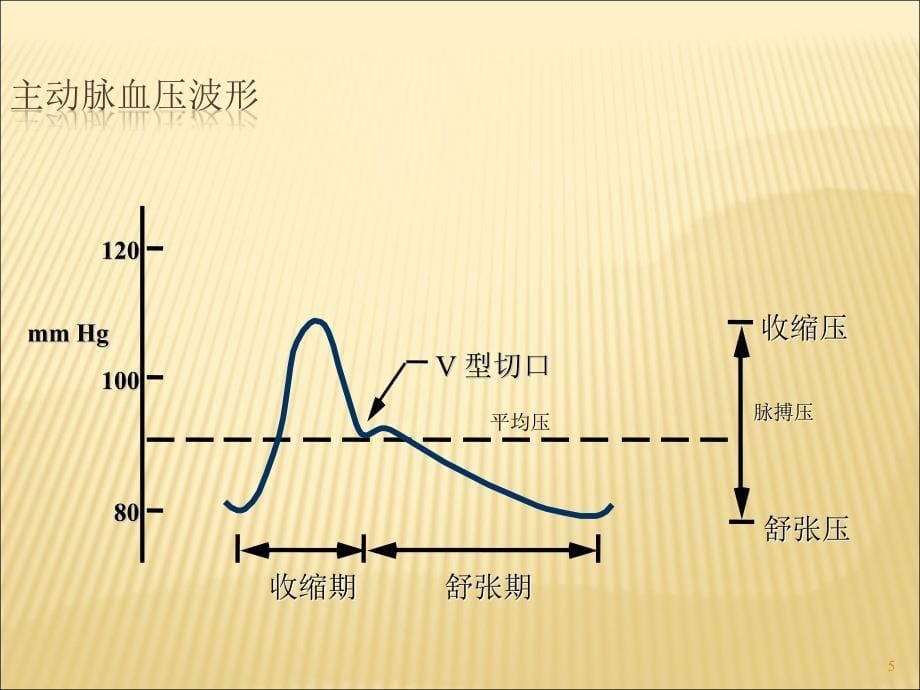 主动脉内球囊反搏术ppt课件_第5页