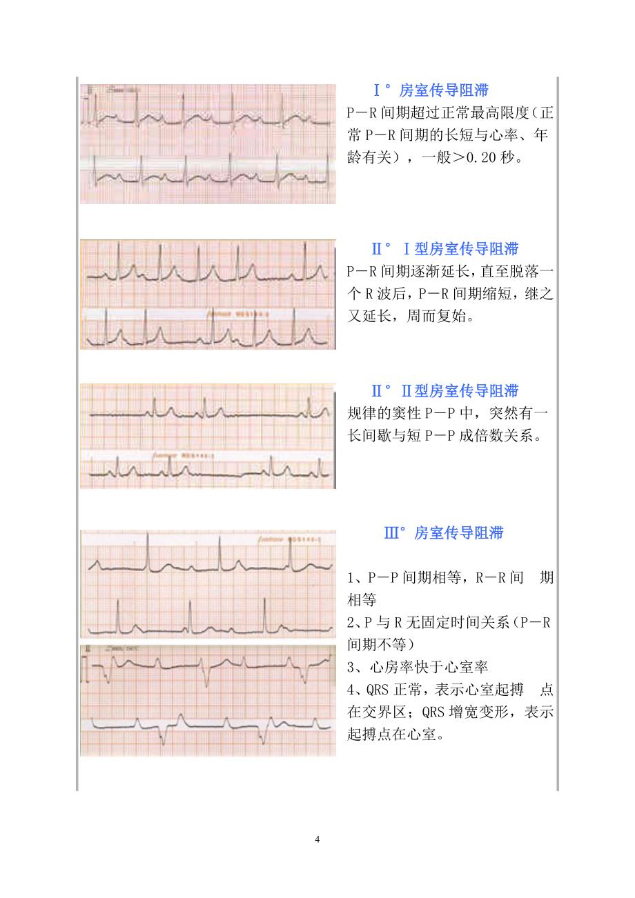 常见心电图诊断图谱.doc_第4页