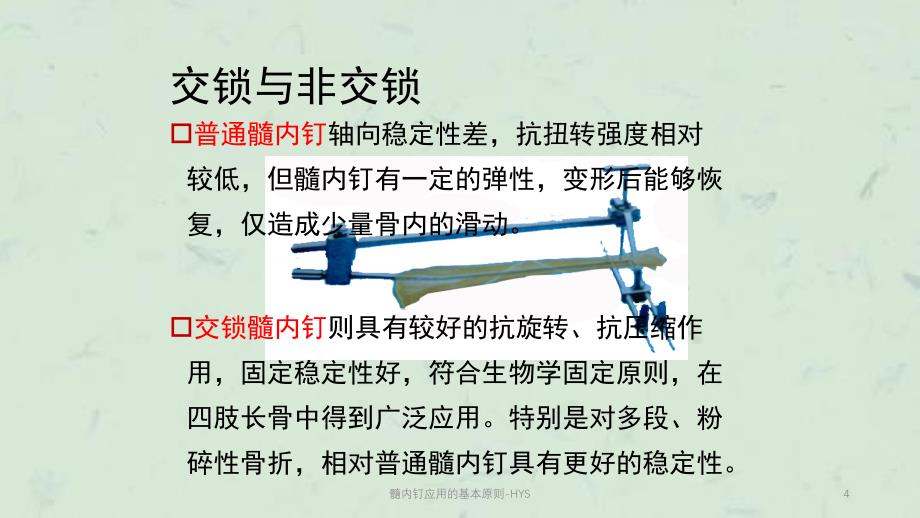 髓内钉应用的基本原则HYS课件_第4页