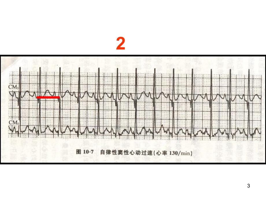 心电图考核图谱PPT课件_第3页