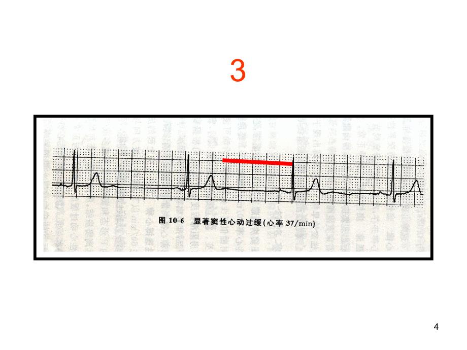 心电图考核图谱PPT课件_第4页