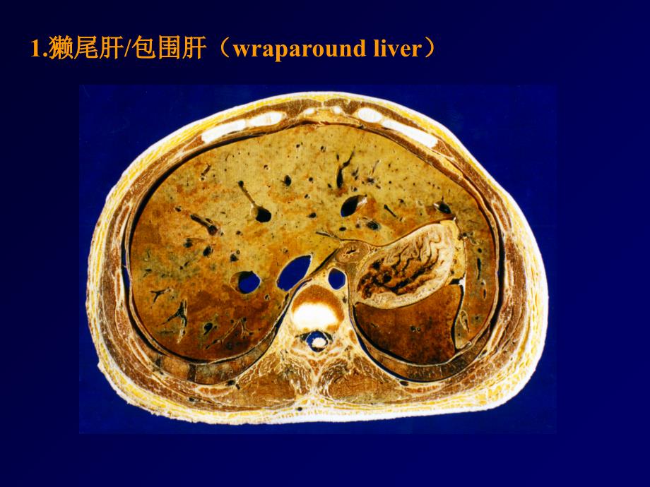 肝脾常见变异_第2页