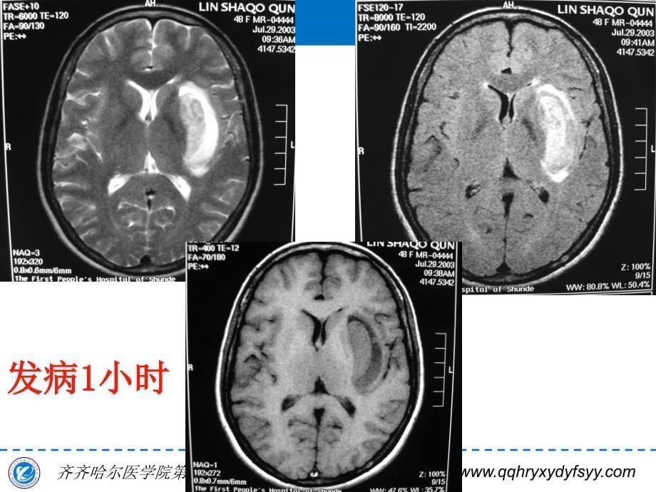 脑内血肿MRI表现规律 李国华_第5页