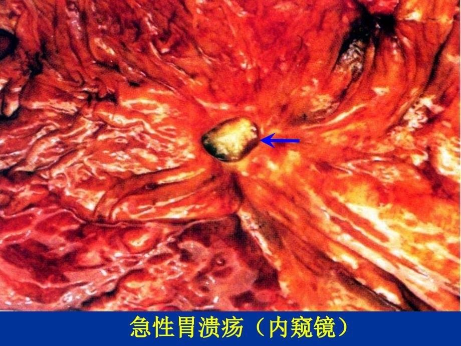 检验病理实验消化、泌尿系统疾病_第5页