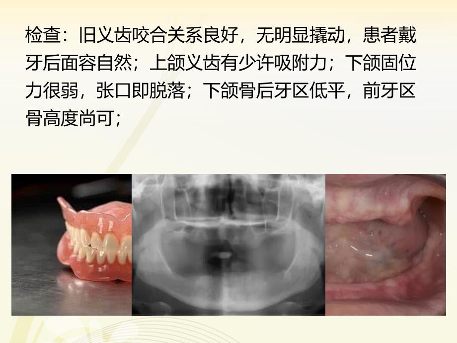 CBL教学无牙颌种植ppt课件_第3页