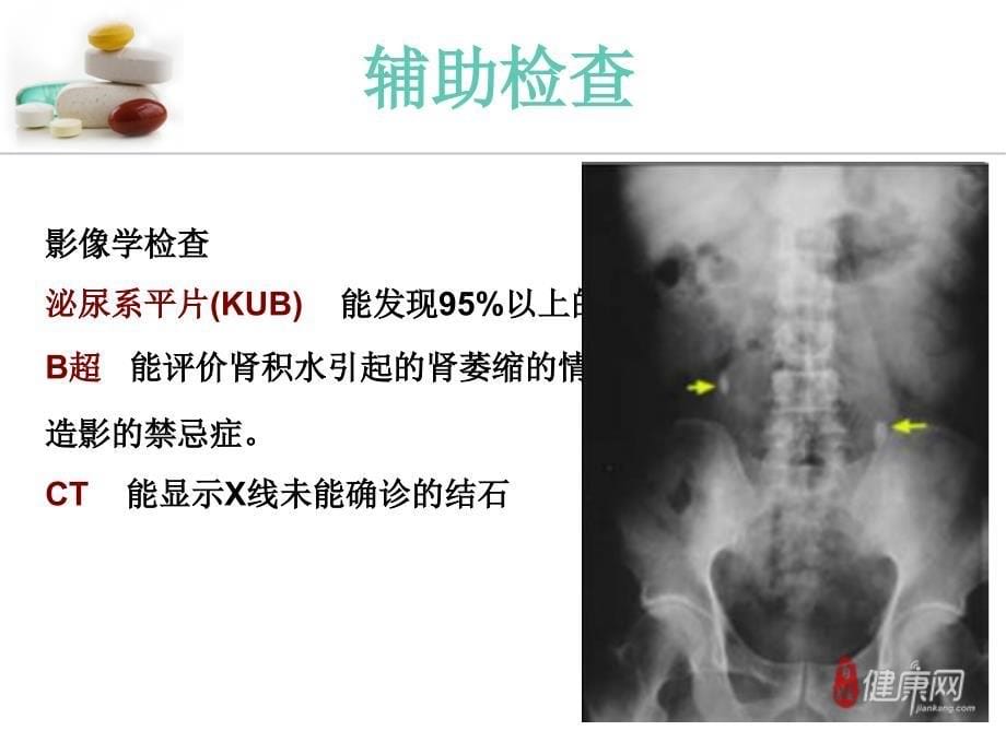 上尿路结石的护理PPT课件_第5页