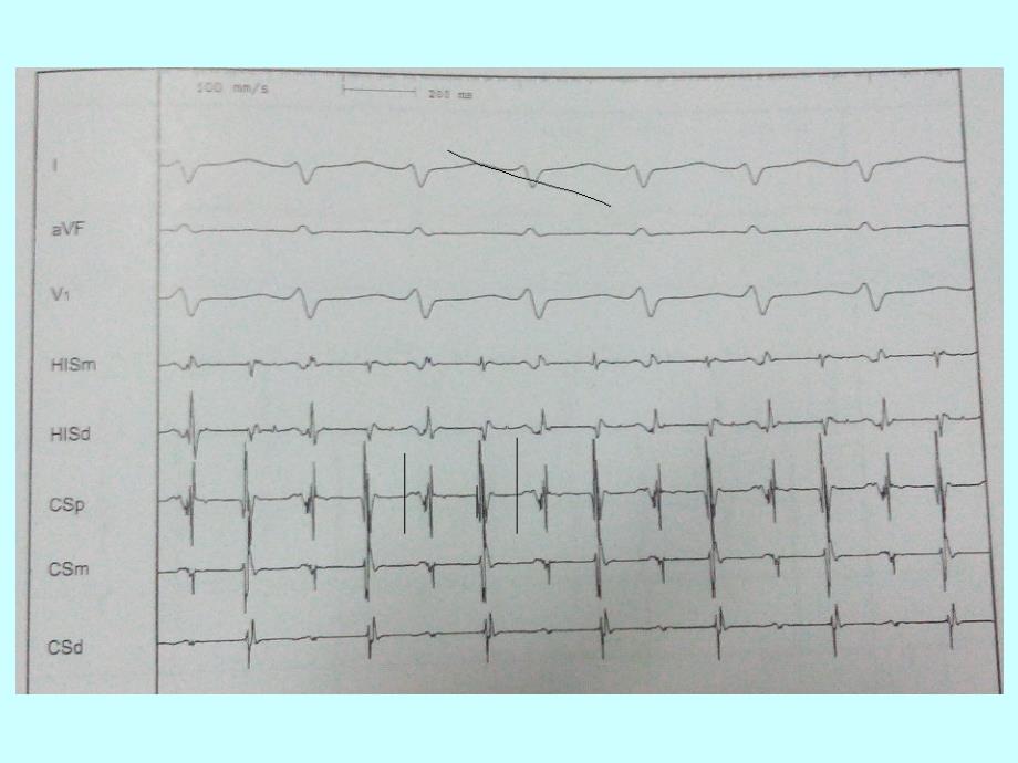 长RP心动过速的诊治与鉴别诊断.ppt_第4页