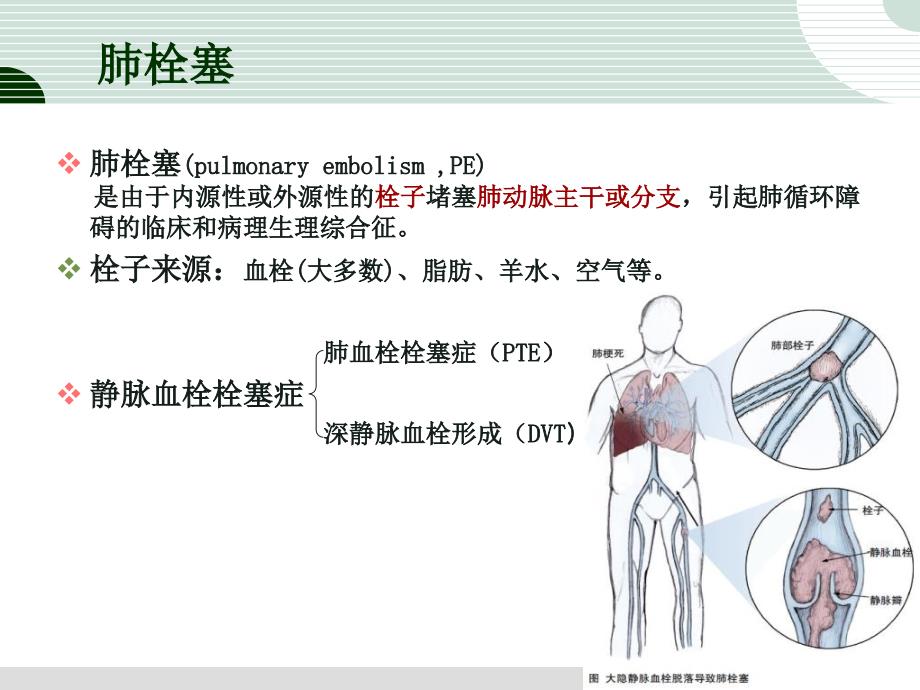 肺栓塞溶栓的护理课件_第3页