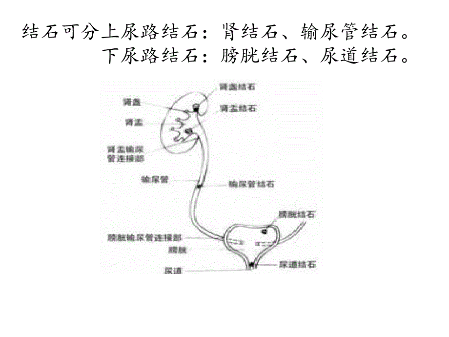 泌尿系结石及护理_第4页