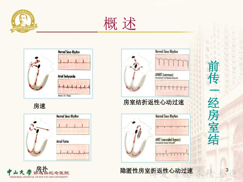 窄QRS波心动过速鉴别诊断PPT参考幻灯片_第3页