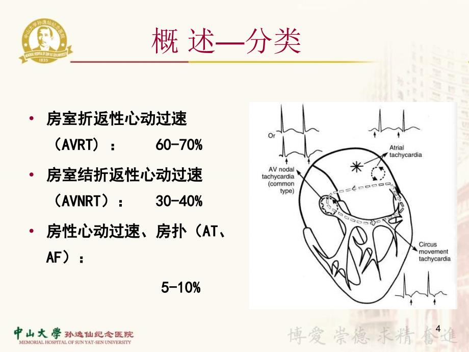 窄QRS波心动过速鉴别诊断PPT参考幻灯片_第4页