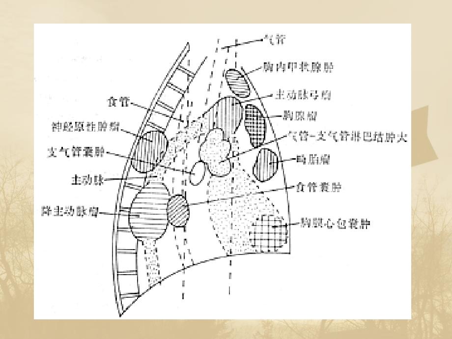 纵隔病变PPT课件_第4页