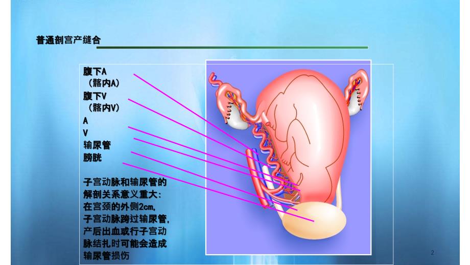 剖宫产手术缝合技术实用课件_第2页