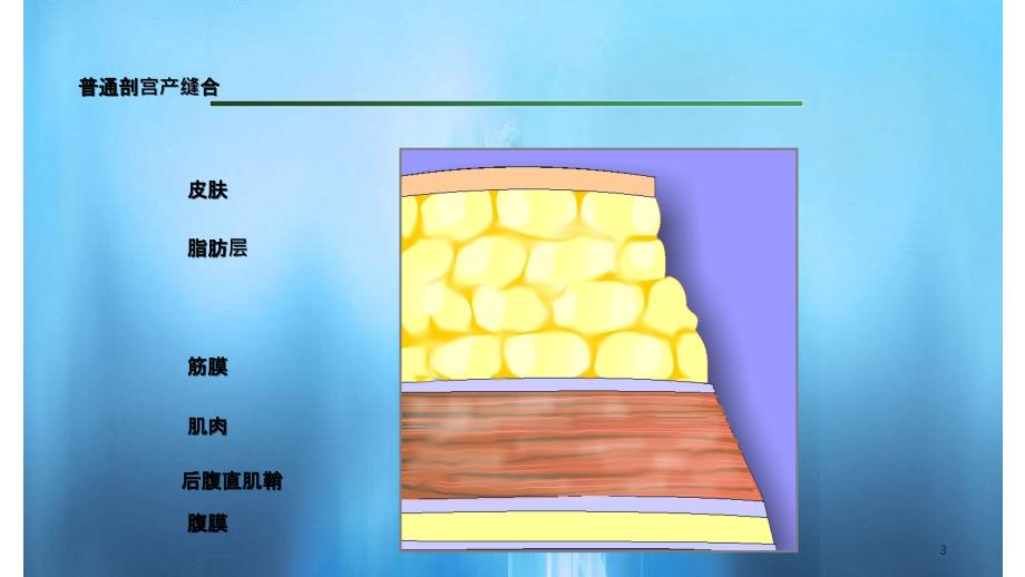 剖宫产手术缝合技术实用课件_第3页