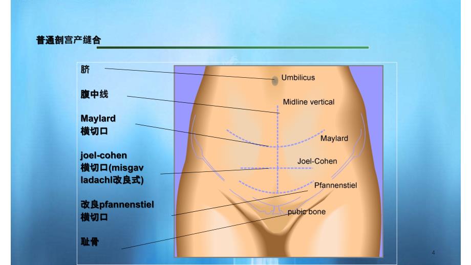 剖宫产手术缝合技术实用课件_第4页