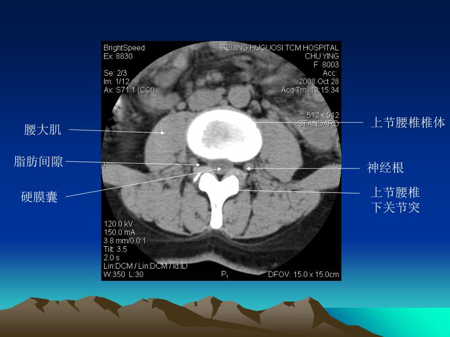 腰椎CT诊断(2)资料_第2页