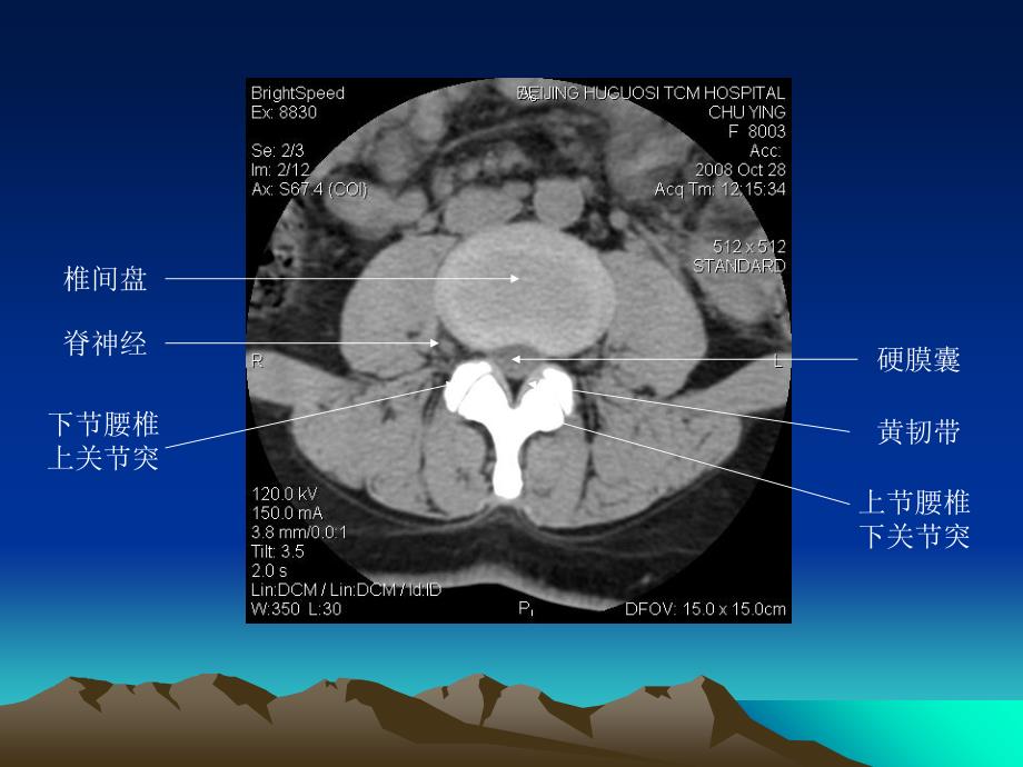 腰椎CT诊断(2)资料_第3页