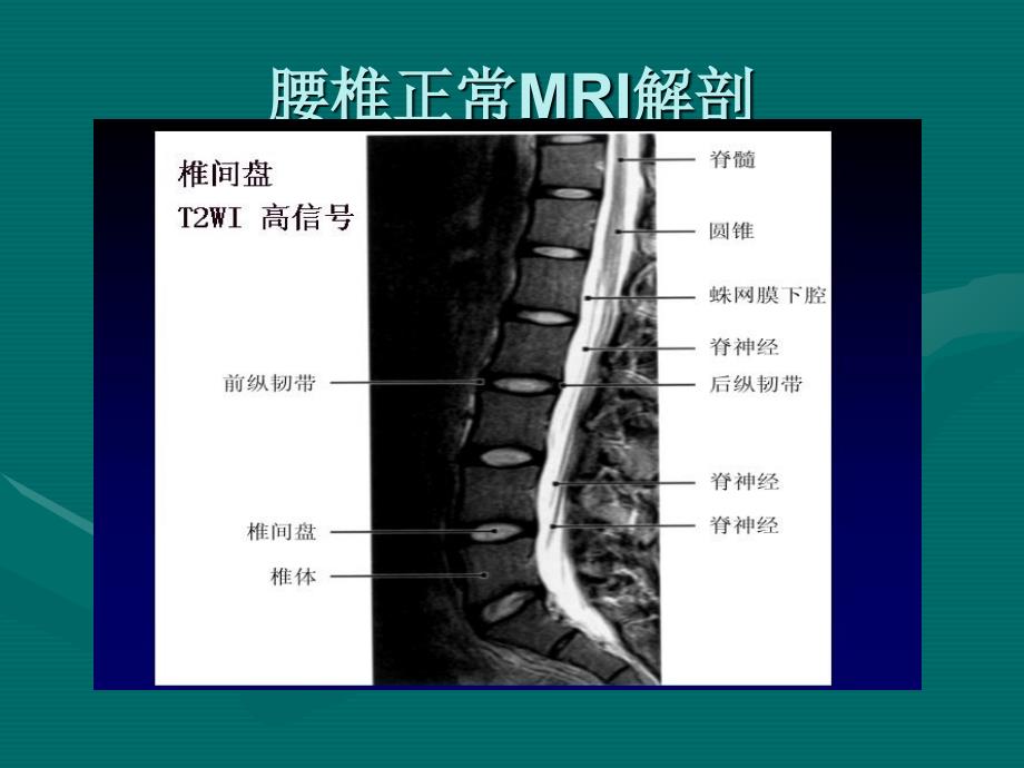 最新腰椎间盘的MRI诊断PPT文档_第1页