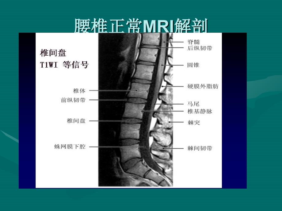 最新腰椎间盘的MRI诊断PPT文档_第2页