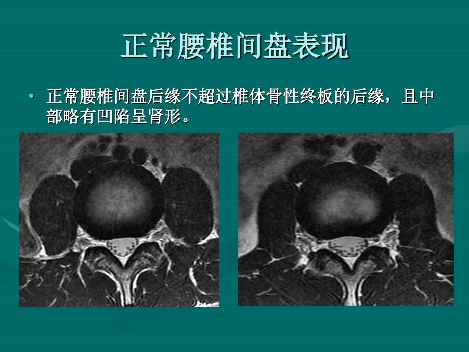 最新腰椎间盘的MRI诊断PPT文档_第4页