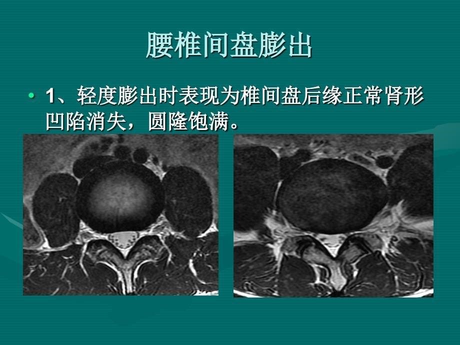 最新腰椎间盘的MRI诊断PPT文档_第5页