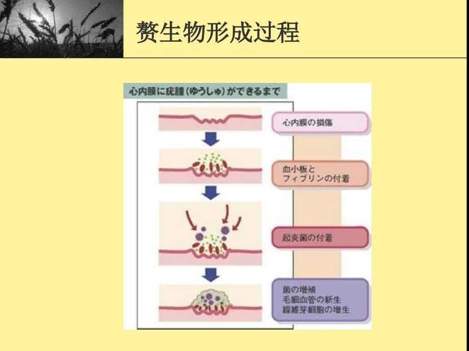 感染性心内膜炎_第5页