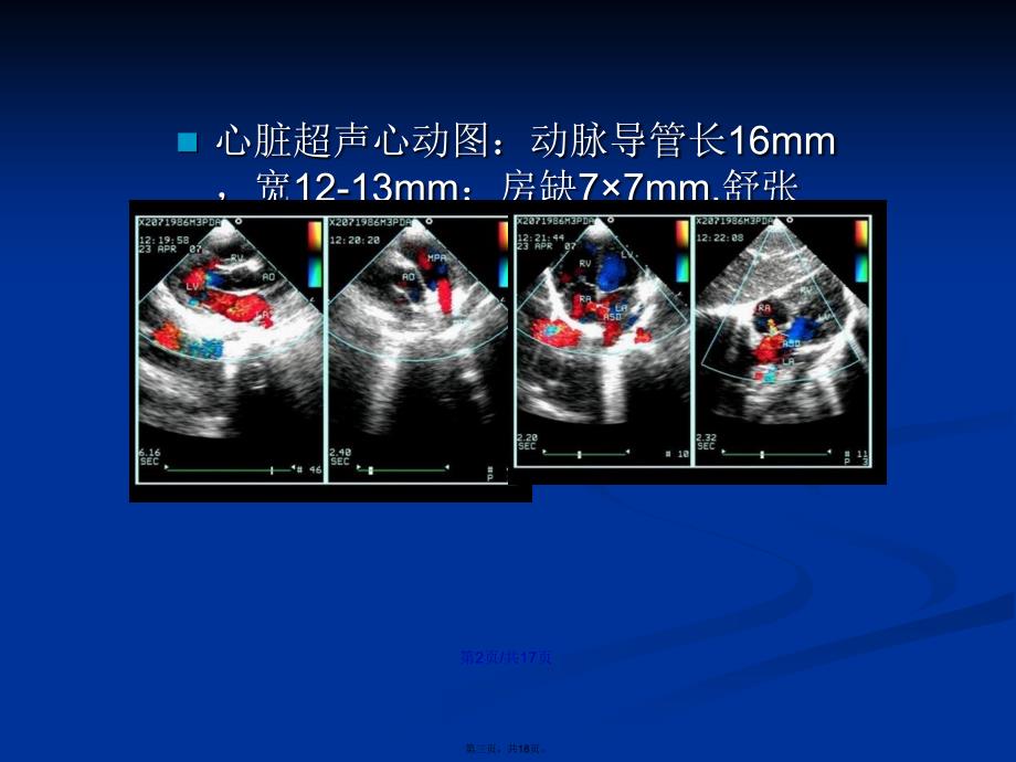 动脉导管未闭封堵术后重肺动脉高压持续加重例学习教案_第3页