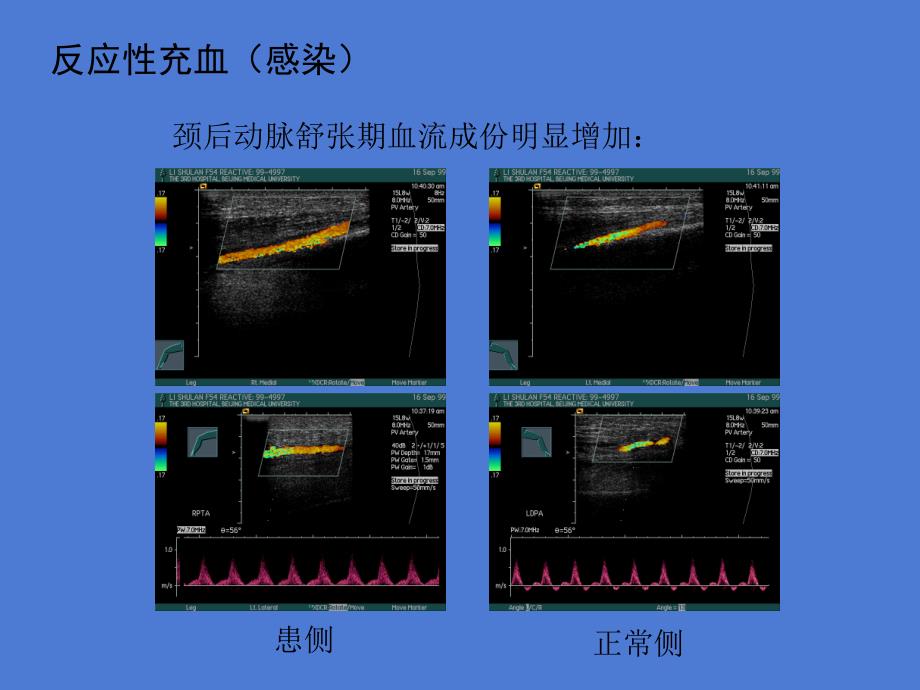 下肢动脉疾病术前后超声诊断课件文档资料_第3页