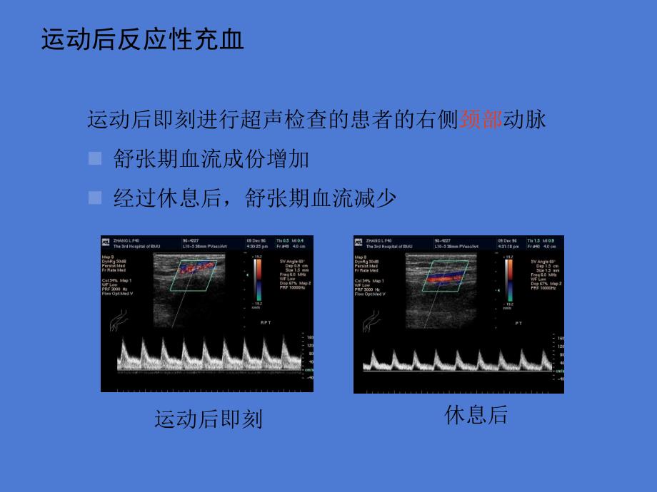 下肢动脉疾病术前后超声诊断课件文档资料_第4页