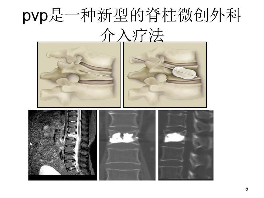 经皮椎体成形术术后护理_第5页