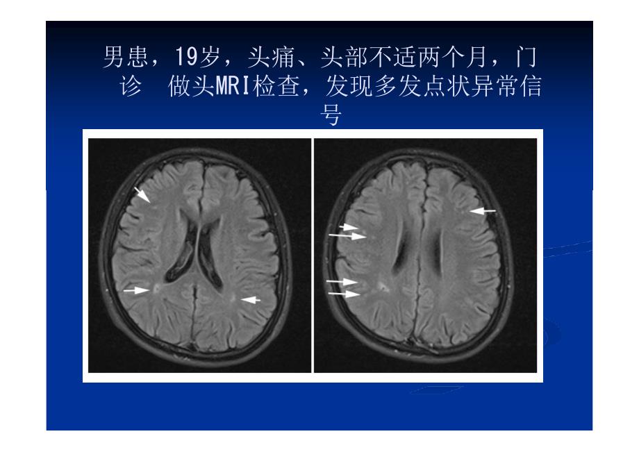 TCD发泡实验在神经内科疾病中应用的典型病例分析_第2页