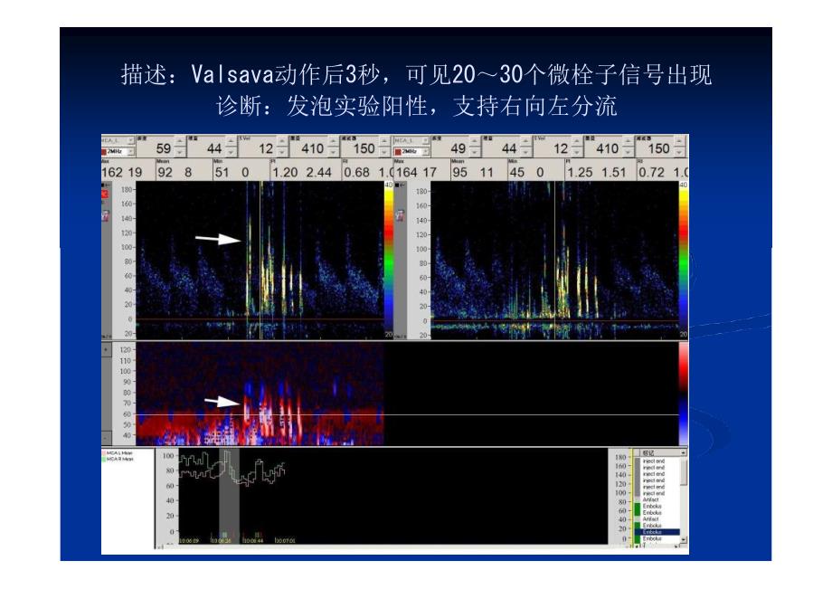 TCD发泡实验在神经内科疾病中应用的典型病例分析_第4页