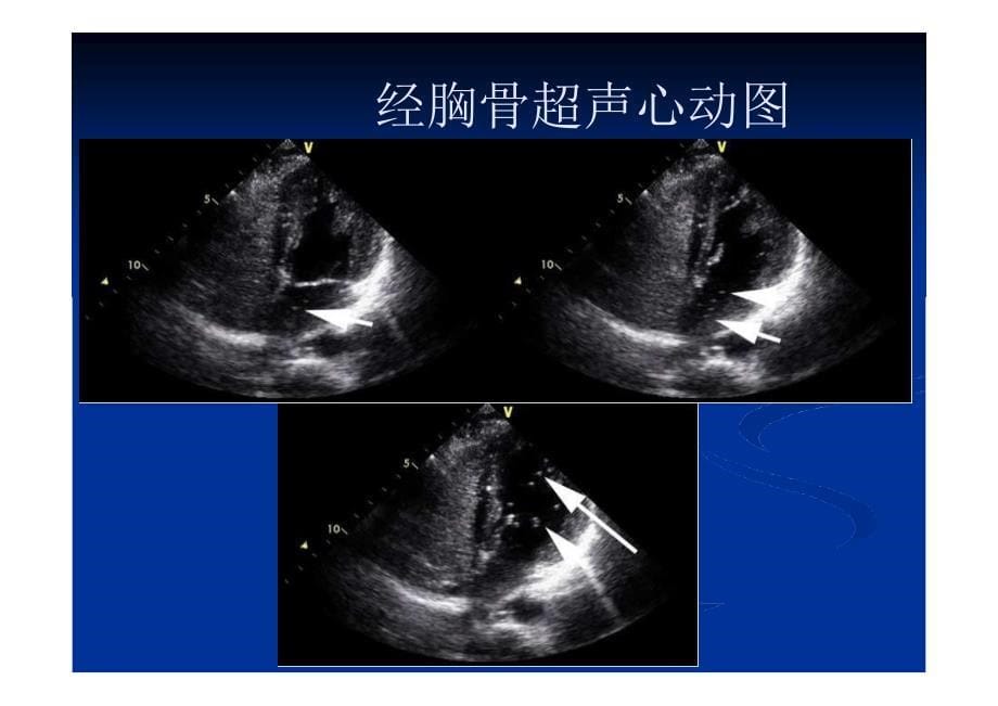 TCD发泡实验在神经内科疾病中应用的典型病例分析_第5页