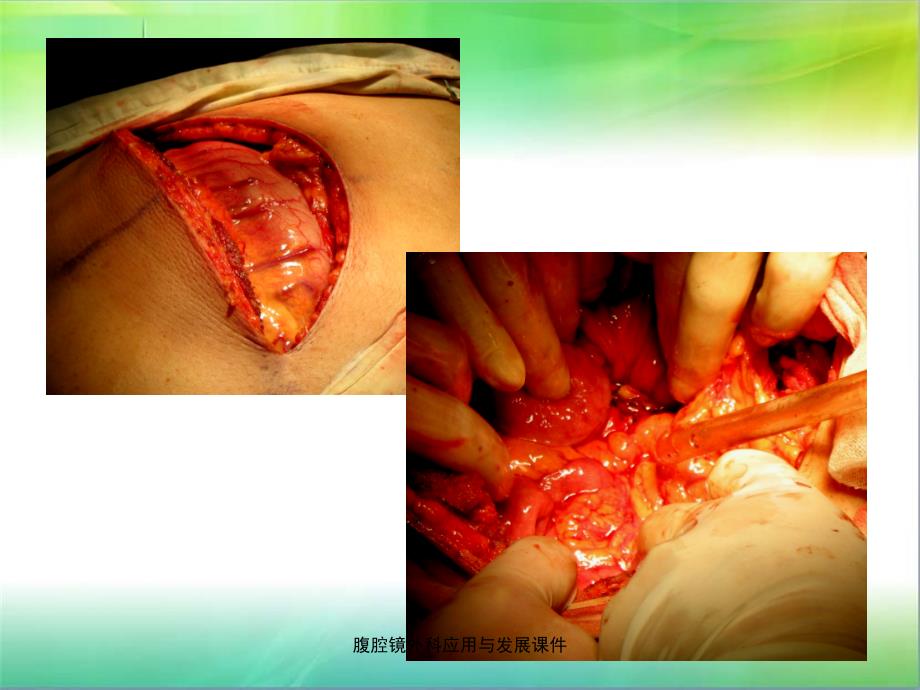 腹腔镜外科应用与发展课件_第3页