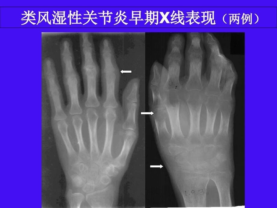 影像五年慢性病骨坏死_第5页