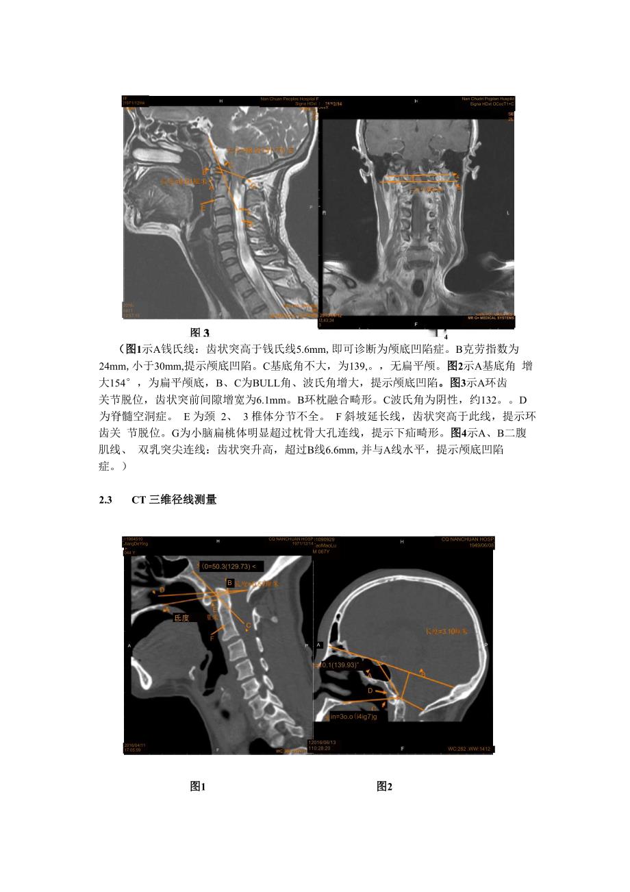 颅底凹陷症影像学诊断_第3页