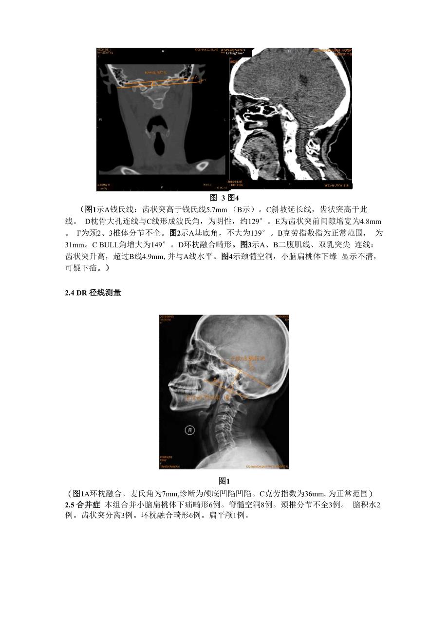 颅底凹陷症影像学诊断_第4页