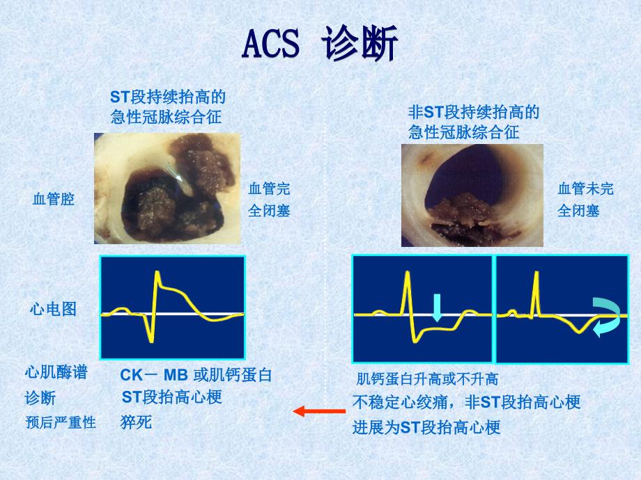 NSTEACS的诊断和治疗——齐国先_第3页